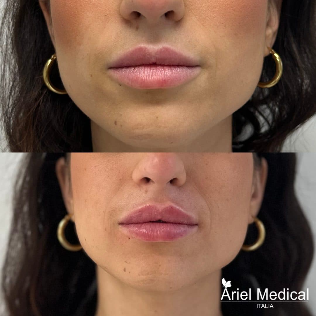 Filler labbra — Prima e dopo — Acido Ialuronico, risultato Ariel Medical