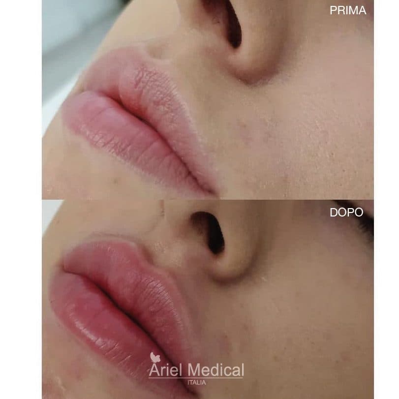 Ringiovanimento viso — Acido Ialuronico, risultato Ariel Medical