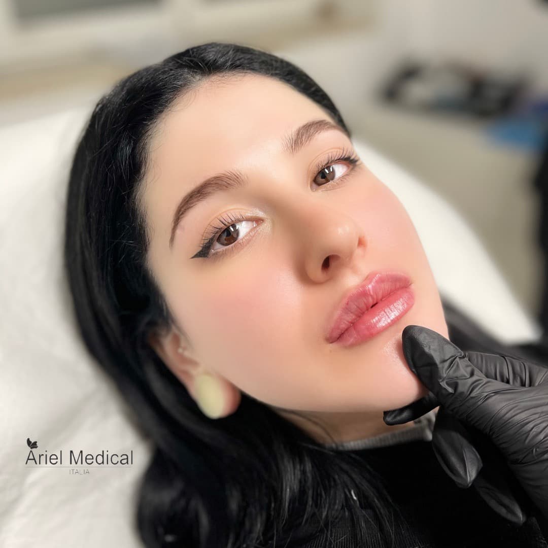 Filler labbra — Risultato naturale — Acido Ialuronico, risultato Ariel Medical