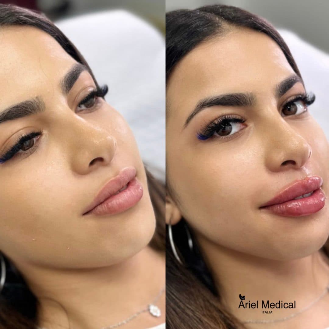 Lifting non chirurgico — Botulino, risultato Ariel Medical