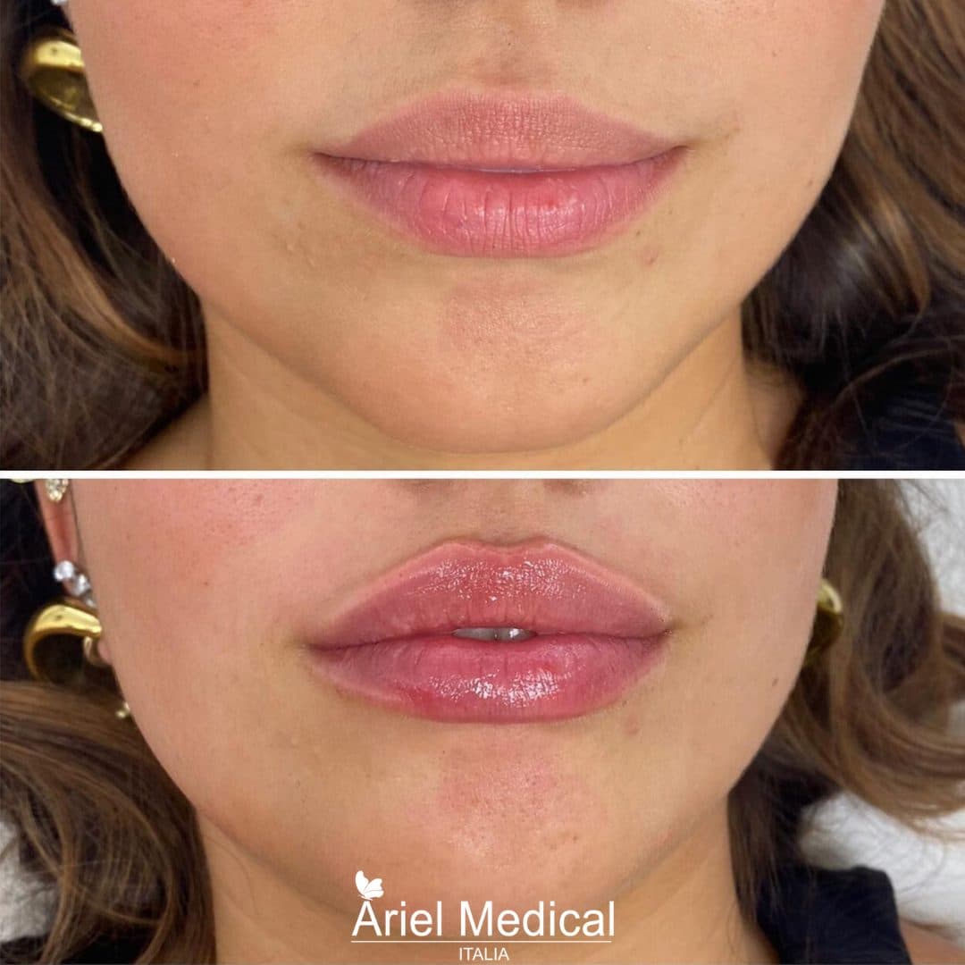 Filler — Armonia del volto — Acido Ialuronico, risultato Ariel Medical