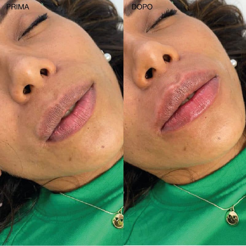 Trattamento rigenerativo — Skin Glow, risultato Ariel Medical