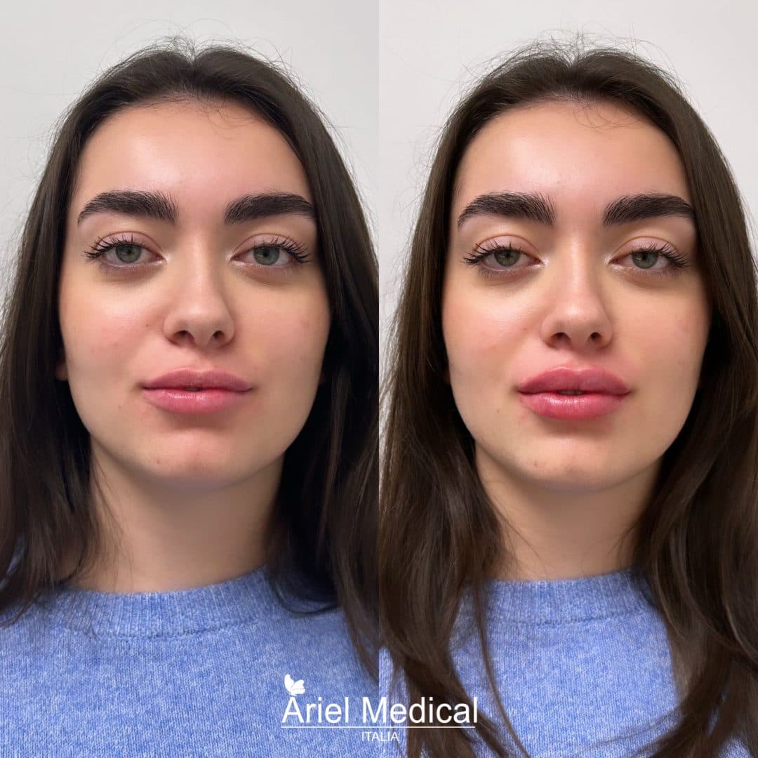 Filler labbra — Volume naturale — Acido Ialuronico, risultato Ariel Medical